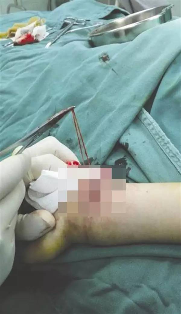  黄蜂三球接受左腕手术根治  